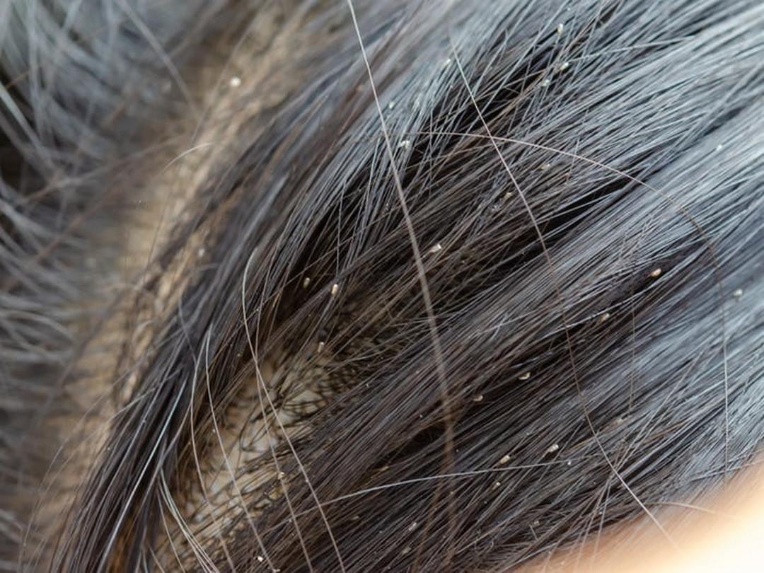 Giải mã giấc mơ thấy con chấy