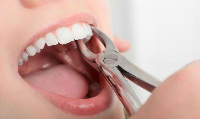 Mơ thấy nhổ răng có ý nghĩa gì?