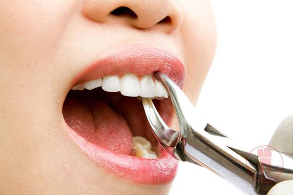 Nằm mơ thấy nhổ răng đánh đề con gì?