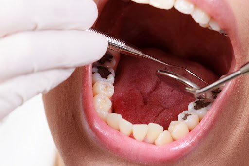 Nằm mơ thấy nhổ răng đánh đề con gì?